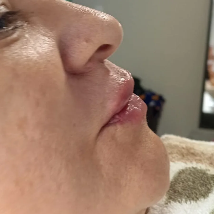 Perfil da paciente antes do preenchimento labial